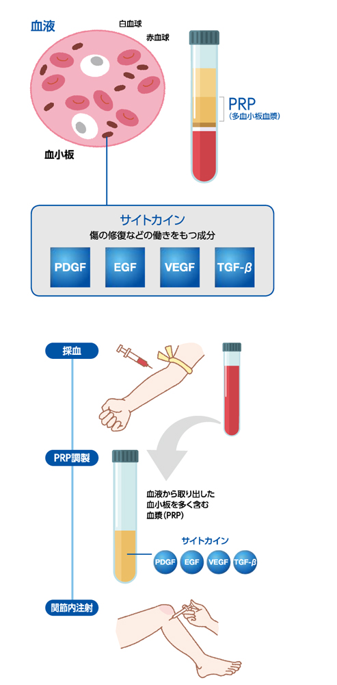 PRPとは
